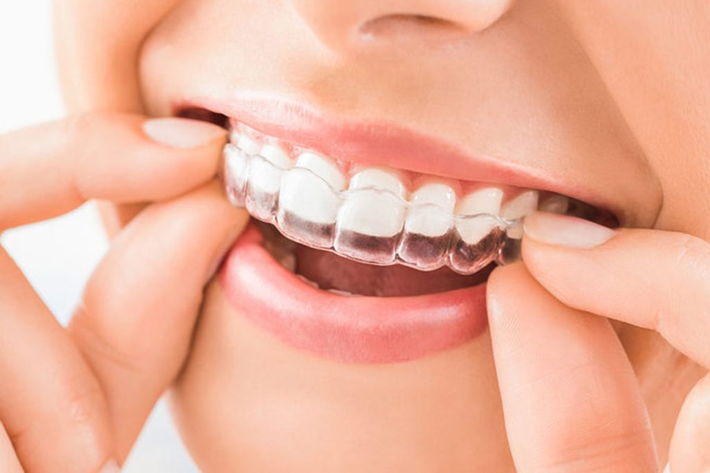 Braces